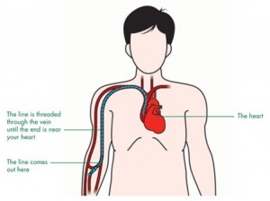 Diagram of a PICC line, obtained from Macmillan