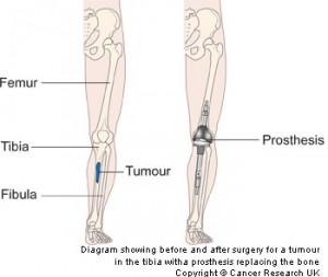 Diagram of an endoprosthesis, obtained from Cancer Research UK